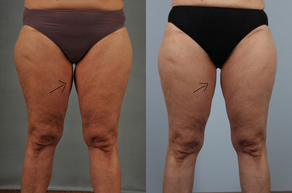 before and after coolsculpting lower front view female patient case 670