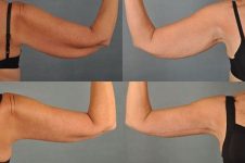 before and after arm lift multiple angle female patient case 2285