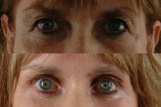 Before and After Eyelid Surgery Blepharoplasty Female Patient front view case 3466