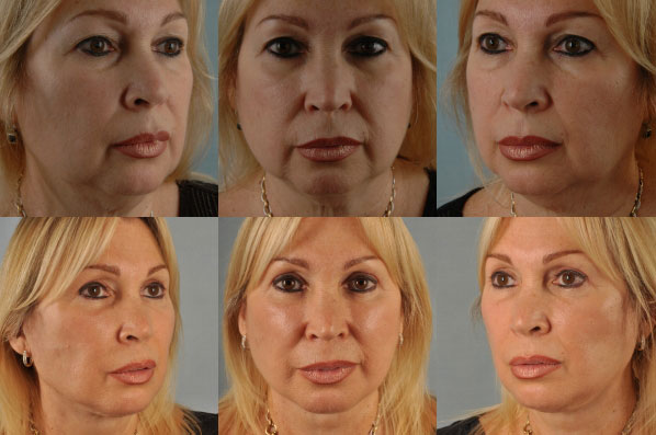 Before and After Eyelid Surgery Blepharoplasty Female Patient multiple angle view case 3470
