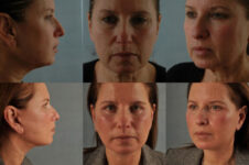 Before and After Eyelid Surgery Blepharoplasty Female Patient multiple angle view case 3474