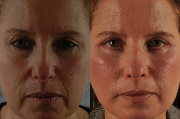 Before and After Eyelid Surgery Blepharoplasty Female Patient front view case 3474