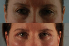 Before and After Eyelid Surgery Blepharoplasty Female Patient front view case 3474