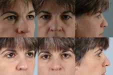 Before and After Eyelid Surgery Blepharoplasty Female Patient multiple angle view case 3483