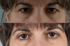 Before and After Eyelid Surgery Blepharoplasty Female Patient front view case 3483