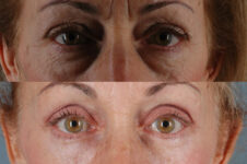 Before and After Eyelid Surgery Blepharoplasty Female Patient front view case 3486