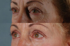 Before and After Eyelid Surgery Blepharoplasty Female Patient left diagonal view case 3486