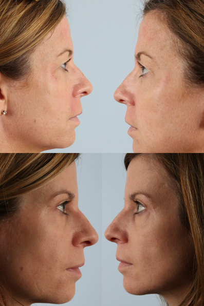 Before and After Eyelid Surgery Blepharoplasty Female Patient right and left side view case 3491