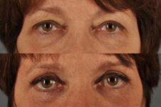Before and After Eyelid Surgery Blepharoplasty Female Patient front view zoomed in case 3498