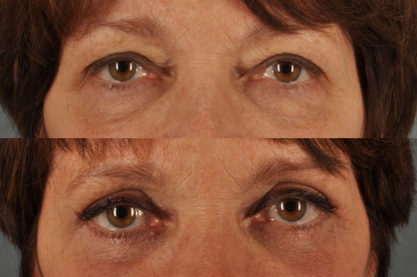 Before and After Eyelid Surgery Blepharoplasty Female Patient front view zoomed in case 3498