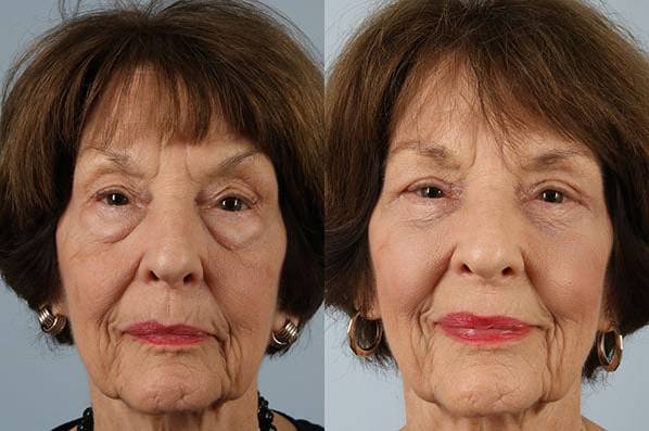 Before and After Eyelid Surgery Blepharoplasty Female Patient front view case 3501