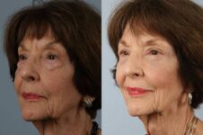 Before and After Eyelid Surgery Blepharoplasty Female Patient left angle view case 3501