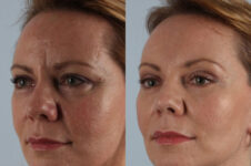 Before and After Eyelid Surgery Blepharoplasty Female Patient left angle view case 3512