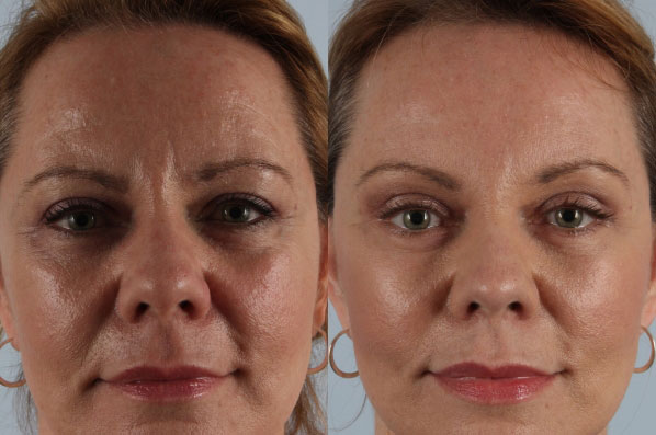 Before and After Eyelid Surgery Blepharoplasty Female Patient front view case 3512