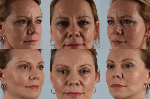 Before and After Eyelid Surgery Blepharoplasty Female Patient multiple angle view case 3512