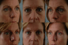 Before and After Eyelid Surgery Blepharoplasty Female Patient multiple angle view case 3516