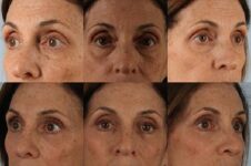 Before and After Eyelid Surgery Blepharoplasty Female Patient multiple angle view case 3519