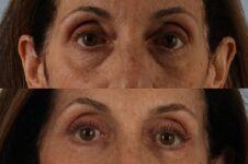 Before and After Eyelid Surgery Blepharoplasty Female Patient front view case 3519