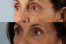 Before and After Eyelid Surgery Blepharoplasty Female Patient left diagonal view case 3519