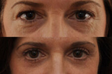 Before and After Eyelid Surgery Blepharoplasty Female Patient Front View Zoomed In Case 3531