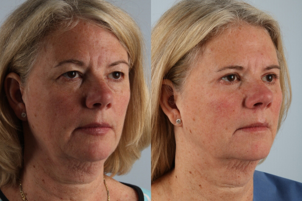 Before and After Eyelid Surgery Blepharoplasty Female Patient right diagonal view case 3535