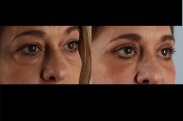 Before and After Eyelid Surgery Blepharoplasty Female Patient right angle view case 3544