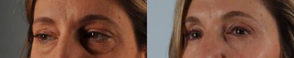 Before and after eyelid surgery female patient left angle view case 3554