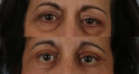 eyelid surgery before and after case 3550 front view