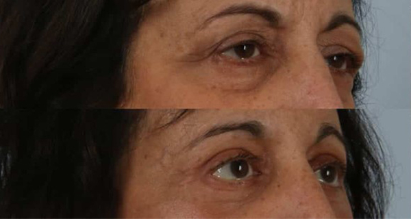 eyelid surgery before and after case 3563 right