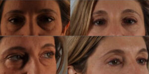 eyelid surgery before and after case 3554