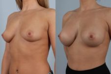 before and after breast augmentation female patient left diagonal view case 999