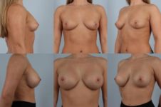 before and after breast augmentation female patient multiple angle view case 999