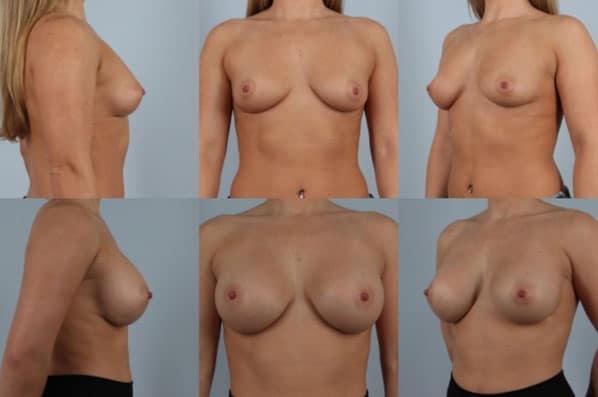 before and after breast augmentation female patient multiple angle view case 999