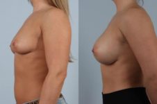 before and after breast augmentation female patient left side view case 999