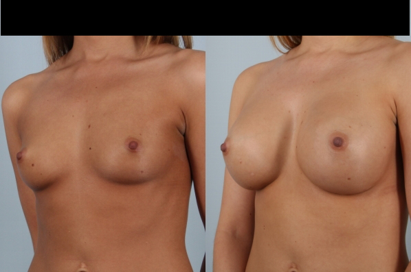 before and after breast augmentation female patient left diagonal view case 1150