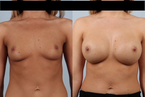 before and after breast augmentation female patient front view case 1150