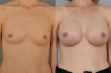 before and after breast augmentation female patient front view case 1159