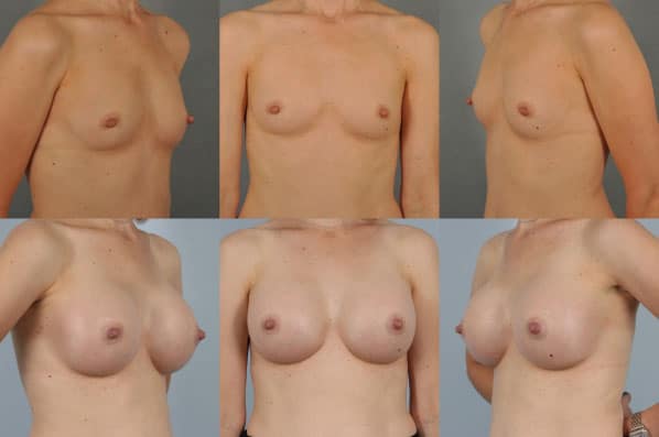 before and after breast augmentation female patient multiple angle view case 1159
