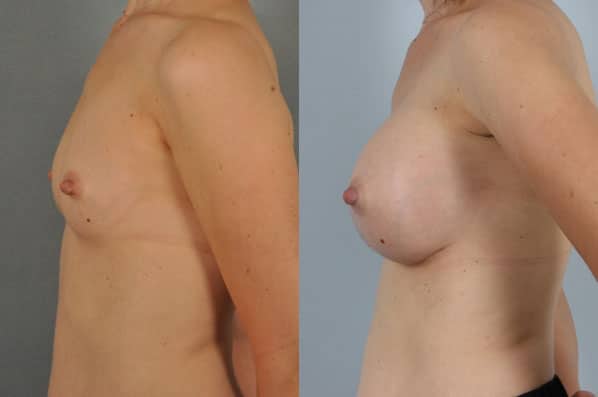 before and after breast augmentation female patient left side view case 1159