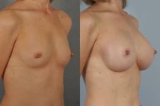before and after breast augmentation female patient right diagonal view case 1159