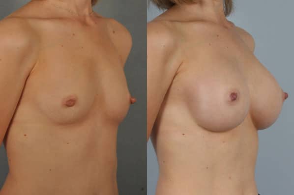 before and after breast augmentation female patient right diagonal view case 1159