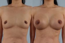 before and after breast augmentation female patient front view case 1164