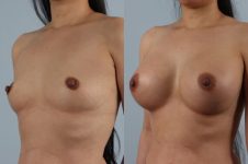 before and after breast augmentation female patient left diagonal view case 1164