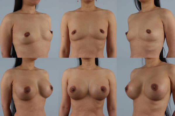 before and after breast augmentation female patient multiple angle view case 1164