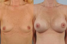 before and after breast augmentation female patient front view case 1191