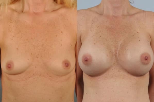 before and after breast augmentation female patient front view case 1191