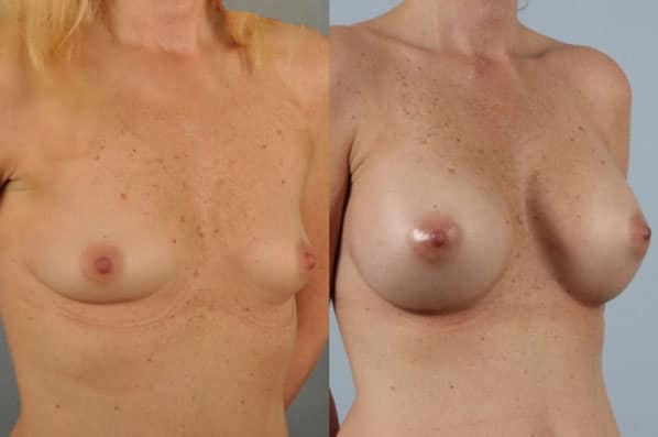 before and after breast augmentation female patient right diagonal view case 1191