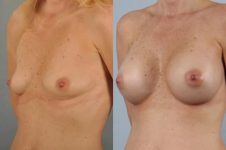 before and after breast augmentation female patient left diagonal view case 1191