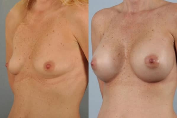 before and after breast augmentation female patient left diagonal view case 1191