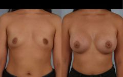 before and after breast augmentation female patient front view case 885